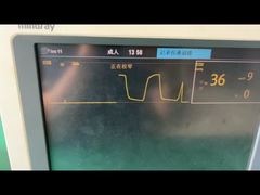 Bliższe spojrzenie: Pułapka wodna Mindray do modułu gazowego do znieczulenia pediatrycznego dla dorosłych 9200-10-10530